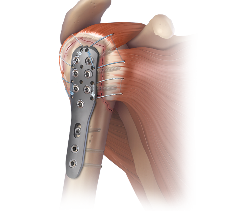 Humeral Fracture Implants