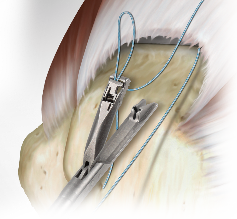 Suture Passers