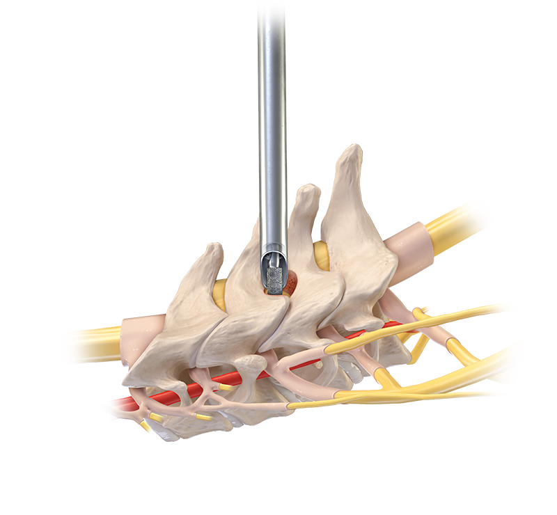 Cervical Foraminotomy and Decompression