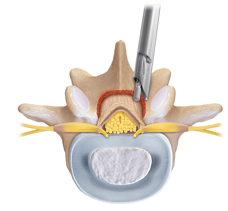 Interlaminar Endoscopic Lumbar ULBD