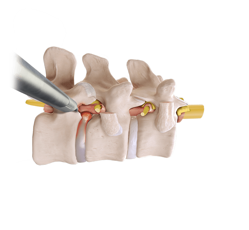 Endoscopic Thoracic Transforaminal Discectomy