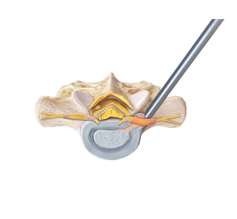 Endoscopic Far Lateral Transforaminal Lumbar Discectomy 
