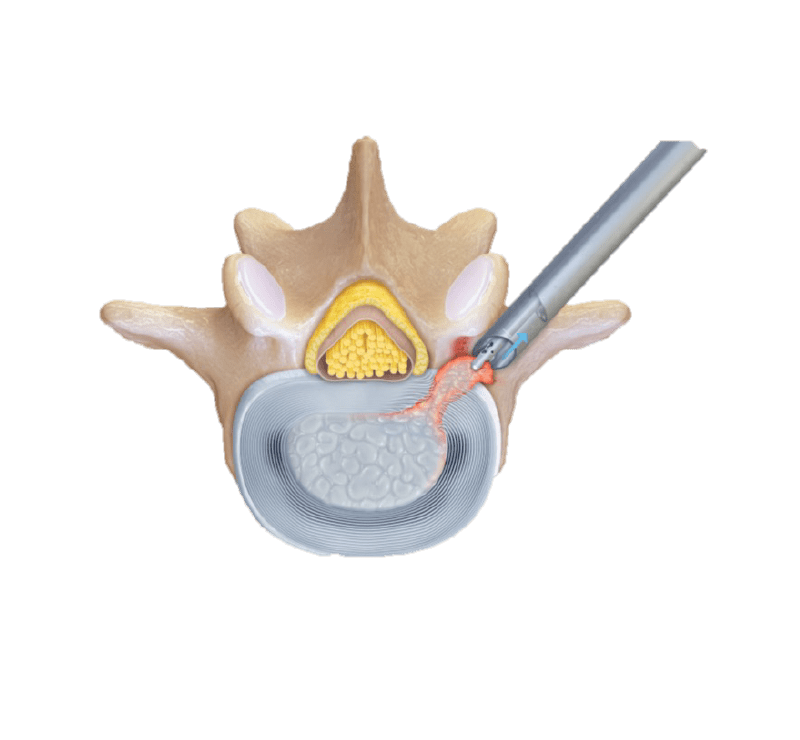 Lumbar Discectomy