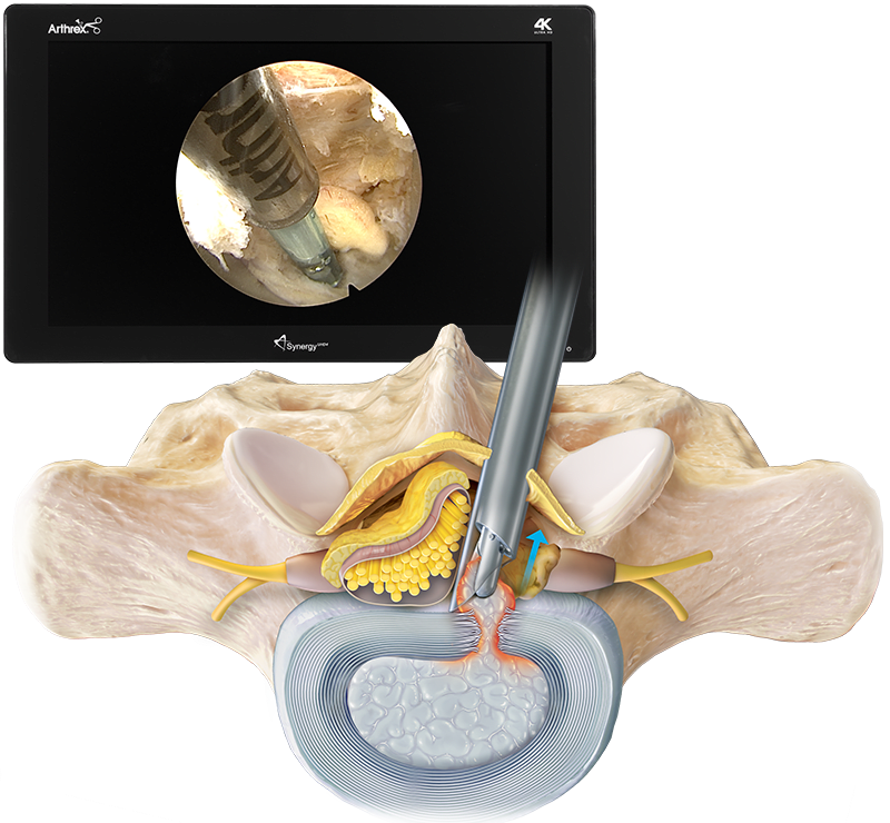 Interlaminar Endoscopic Discectomy