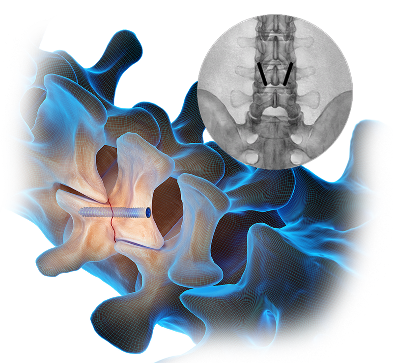 Cervical Fracture Repair