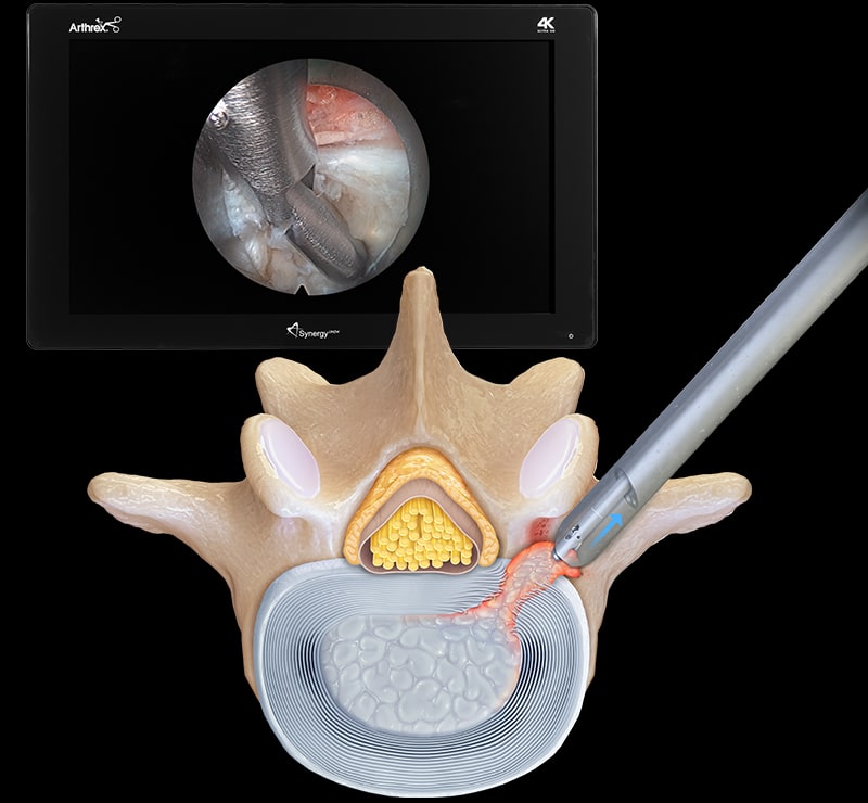 Transforaminal Endoscopic Discectomy