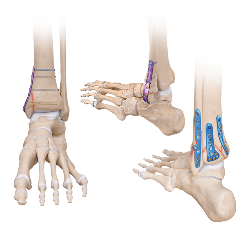 Titanium Ankle Fracture
 System