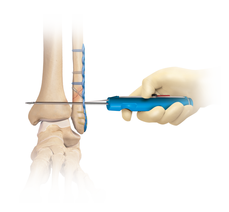 Syndesmosis TightRope<sup>®</sup> XP Implant System