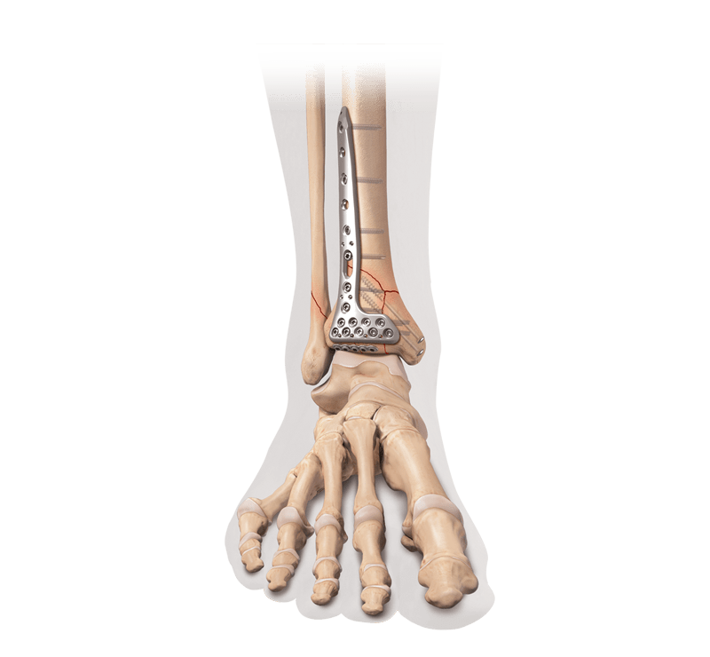 Fixação interna para fratura distal da tíbia/pilão