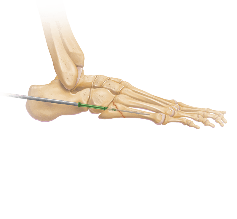 Jones Fracture