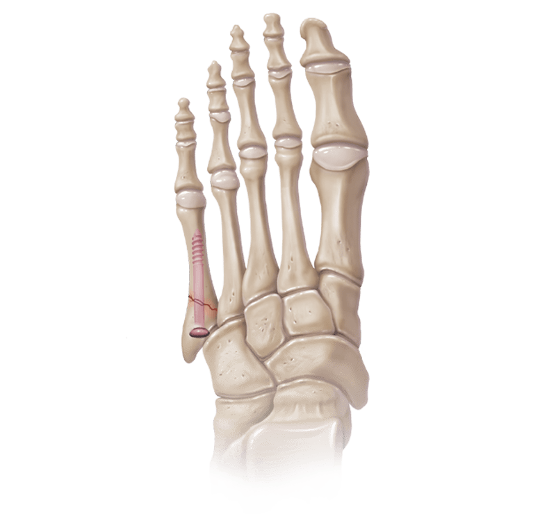 Jones Fracture Repair