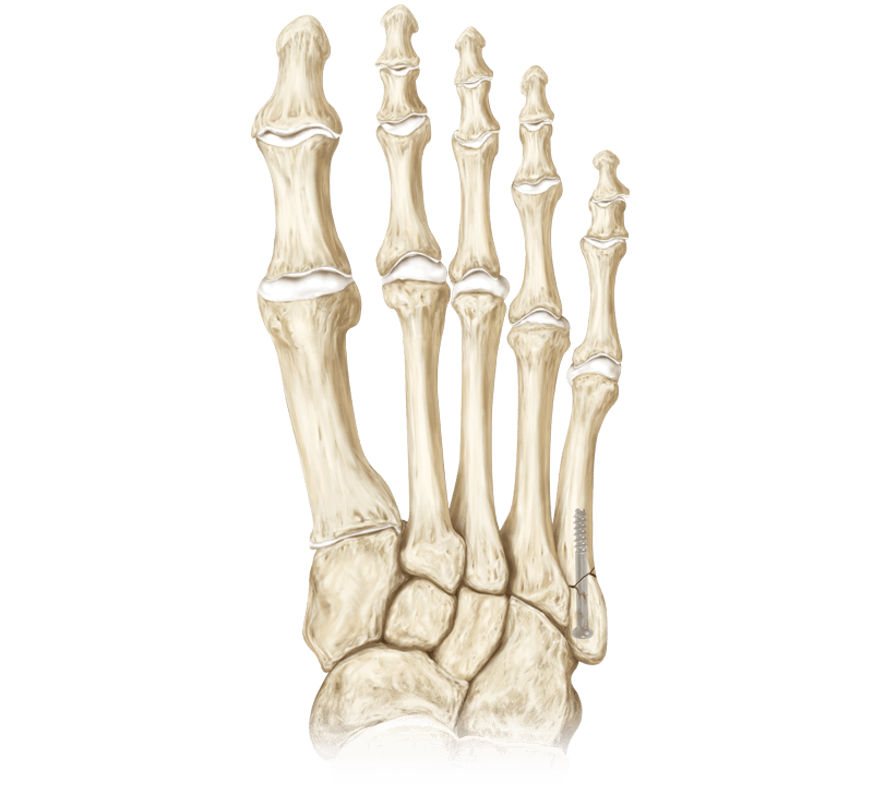 Metatarsal Fracture Repair