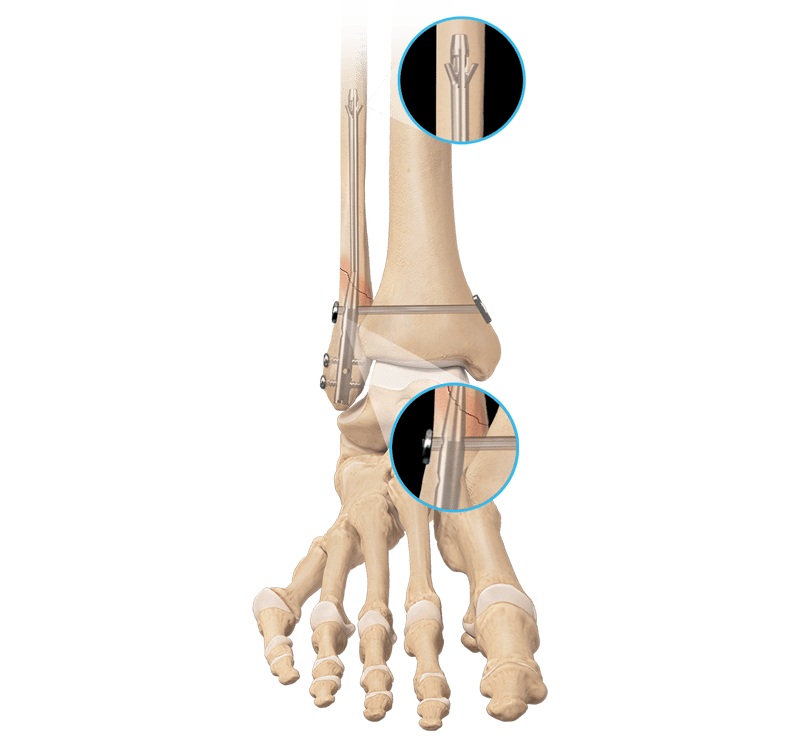 Ankle Fracture