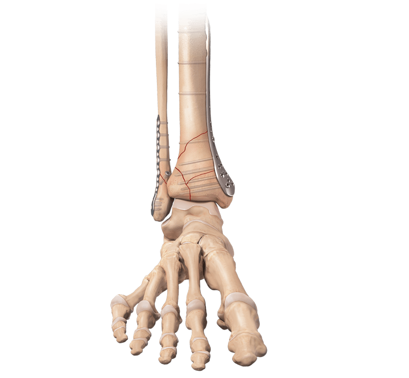 Distal Tibia Plating System