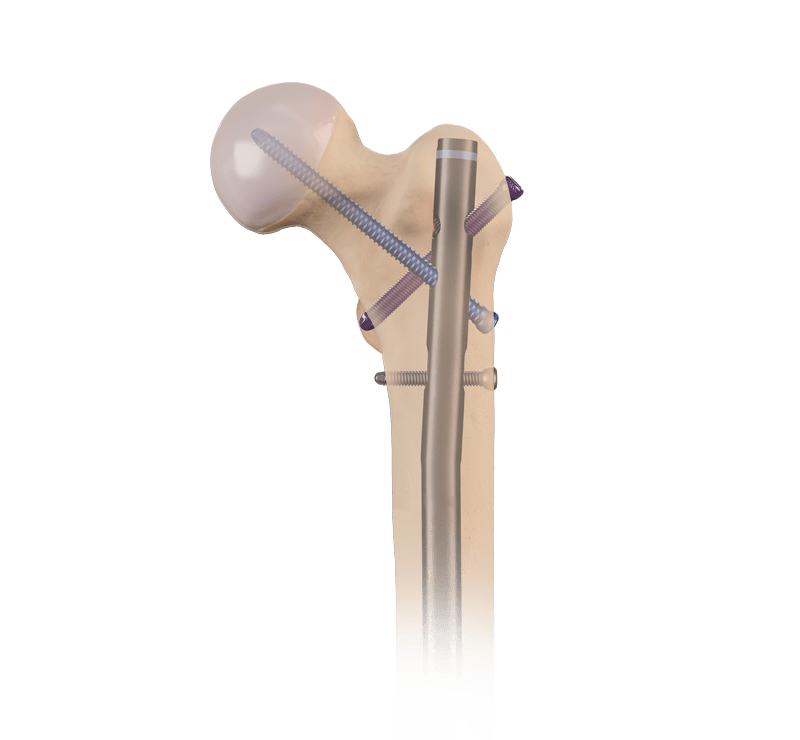 Antegrade Femoral Nail System