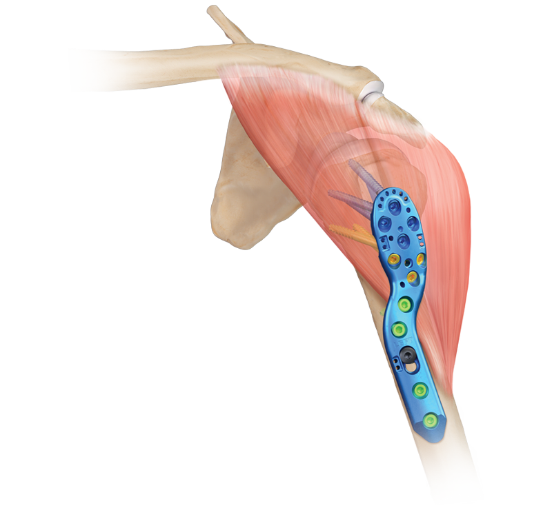 Proximal Humerus Plating System