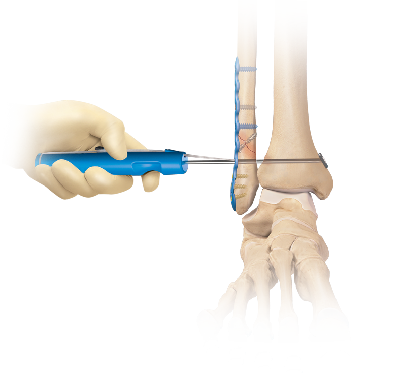 Syndesmosis TightRope<sup>®</sup> XP Implant System