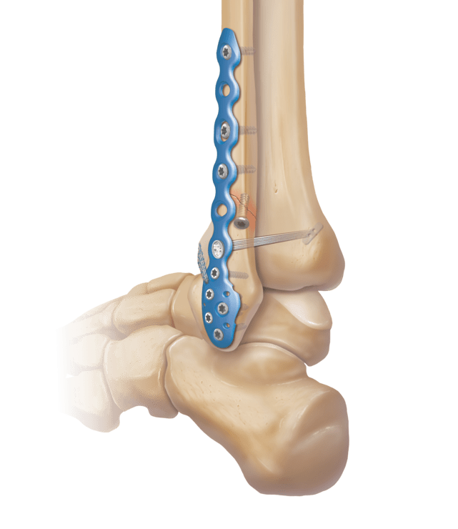 Titanium Ankle Fracture
 System