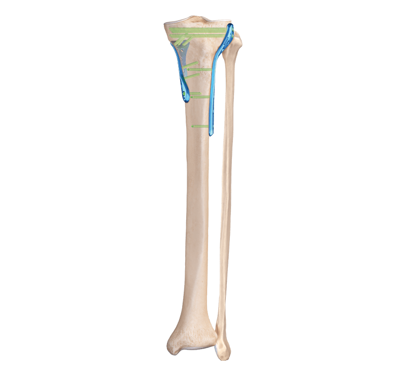 Proximal Tibia Fracture
