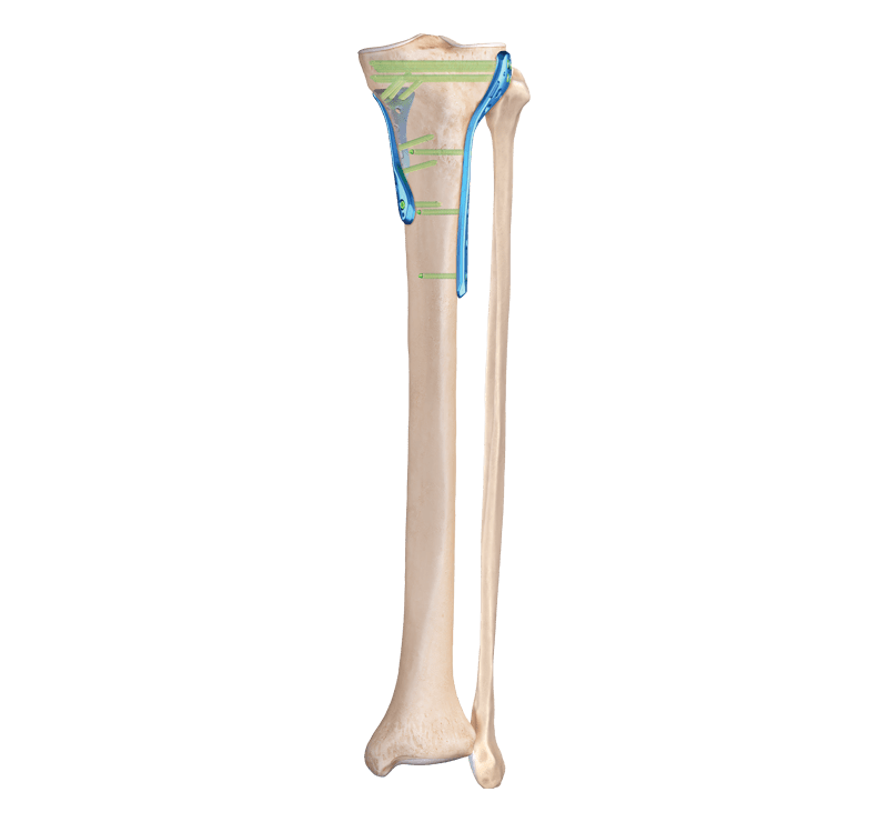 Plattensystem aus Titan für die proximale Tibia