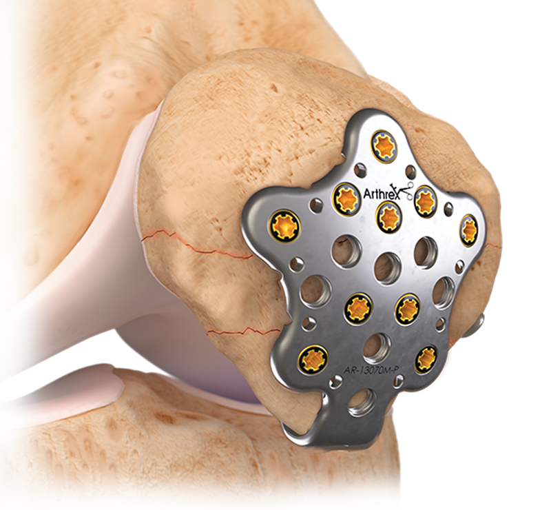 Patella SuturePlate™ II