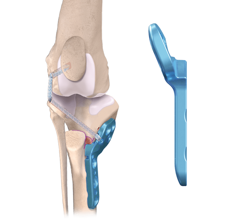OrthoLine™ Medial Patella Luxation (MPL) System