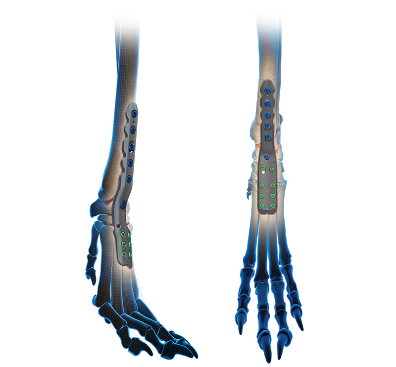 OrthoLine™ Arthrodesis Plating System