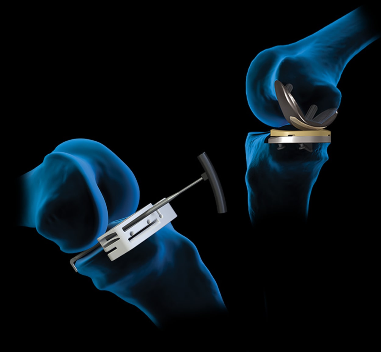 <p>AAOS 2025 Annual Meeting: Knee Arthroplasty Feature Products</p>