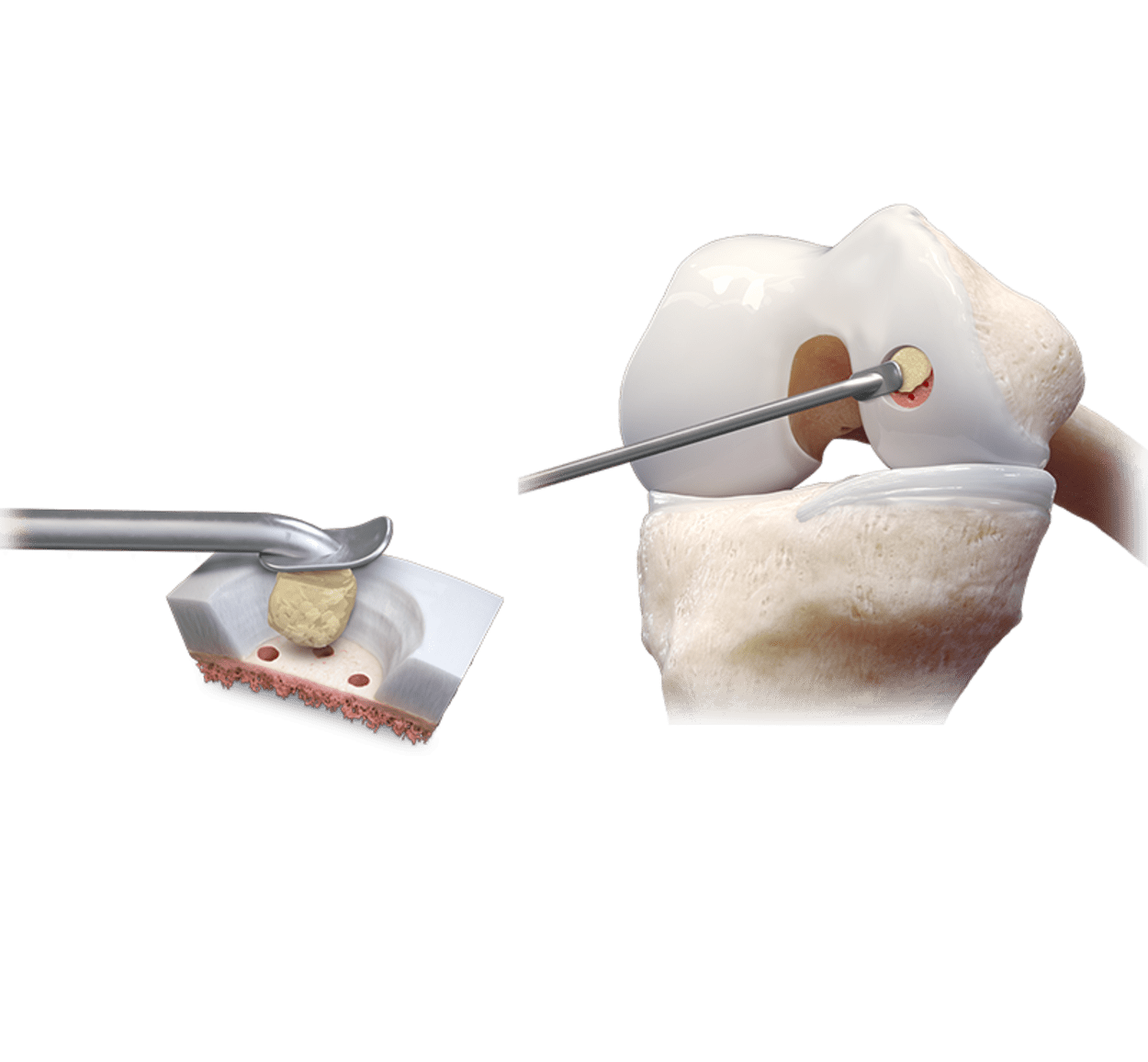 <p>BreakThrough™ With Christopher Adams, MD—AutoCart Technique</p>