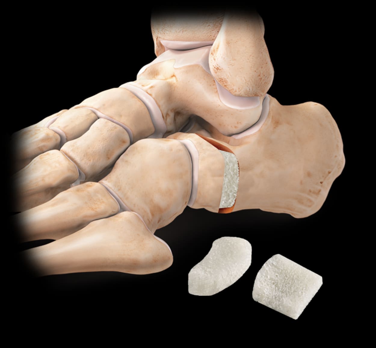 <p>AlloSync™ Anatomic &nbsp;Reconstruction Wedge</p>