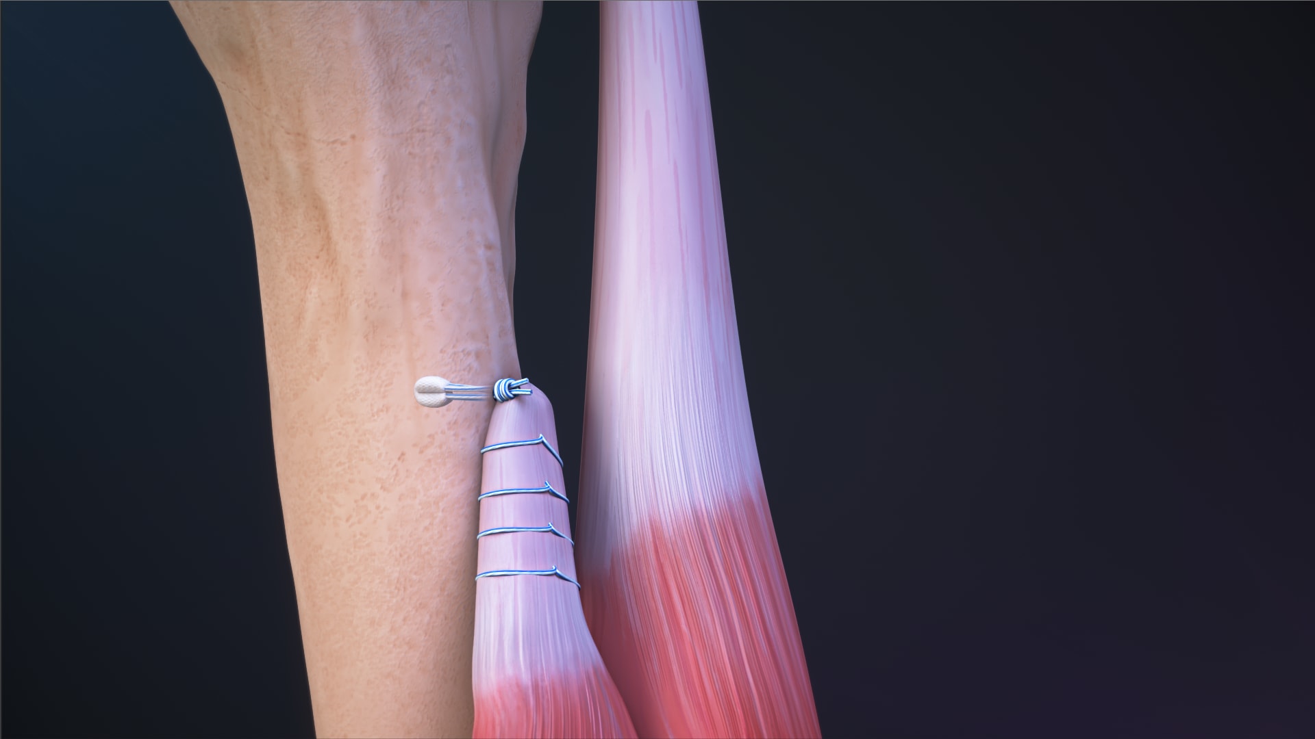 Subpectoral Biceps Tenodesis Using the FiberTak® Button Implant System