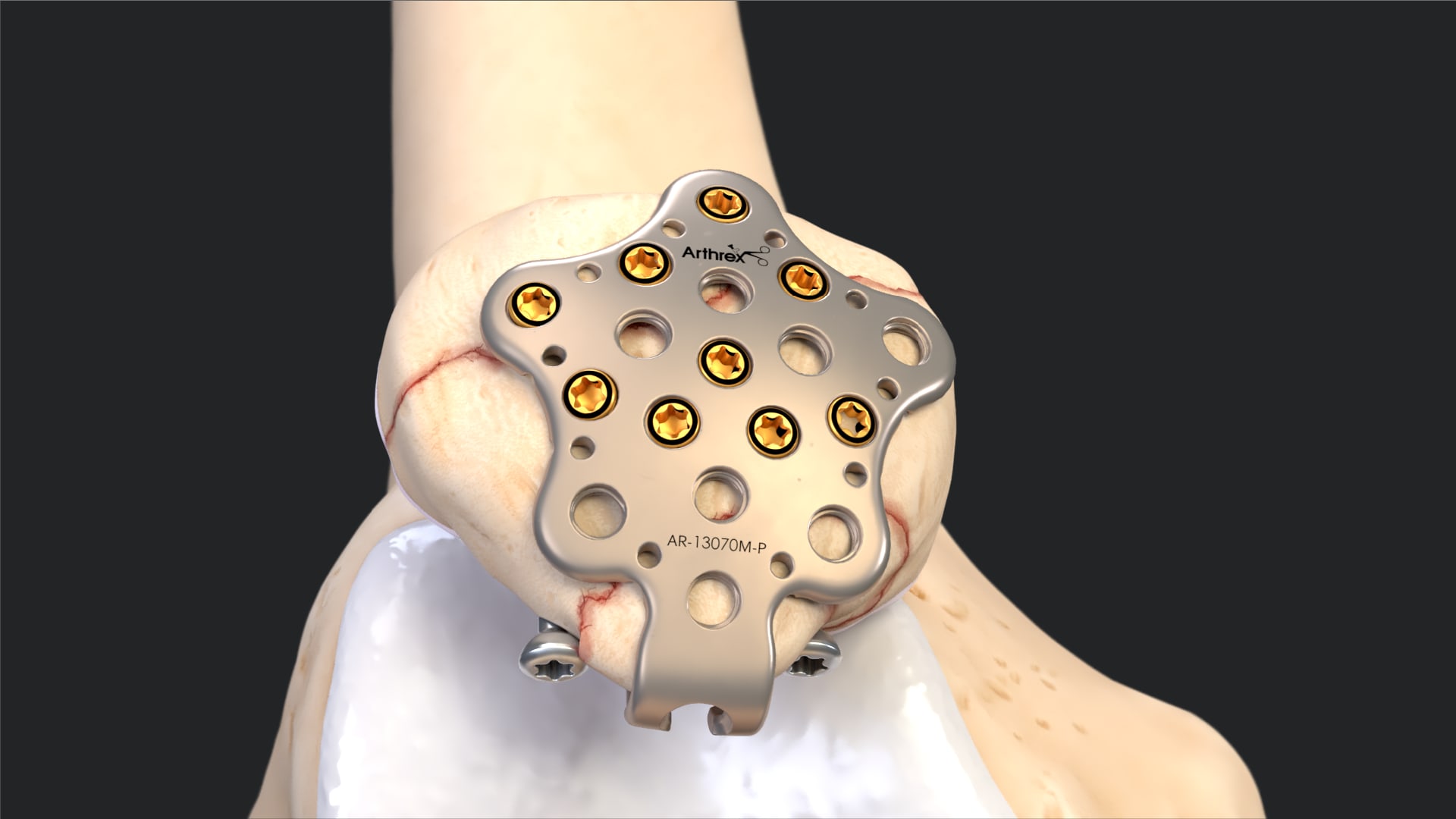 SuturePlate™ II Patella Fracture Repair System