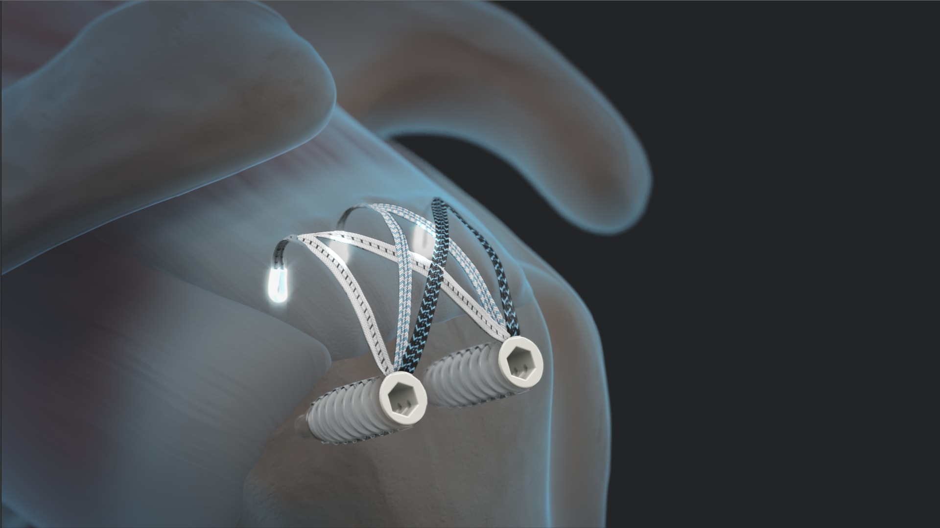 Arthrex - FiberTak® SpeedBridge™ Repair
