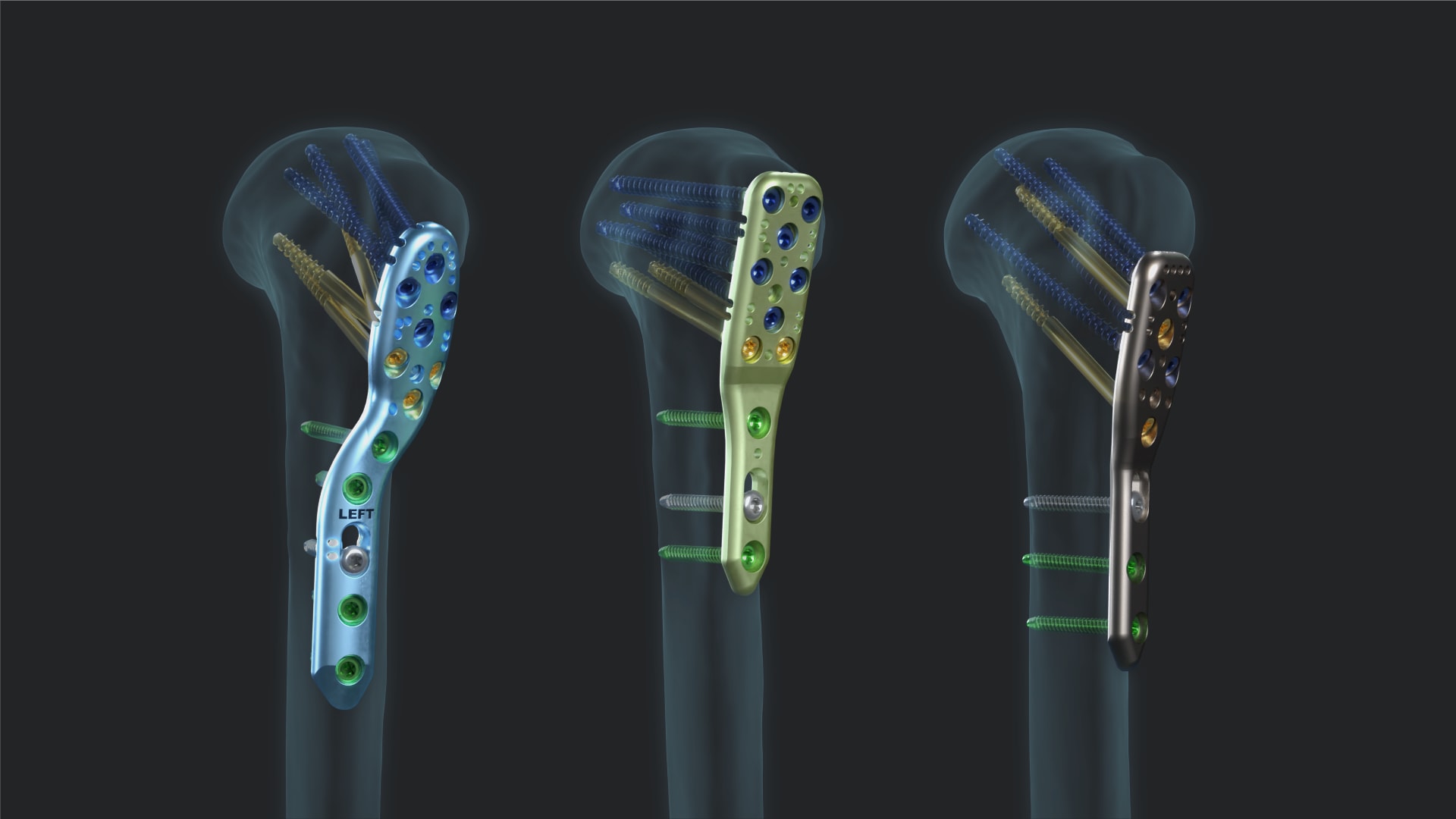 Proximal Humerus Plating System