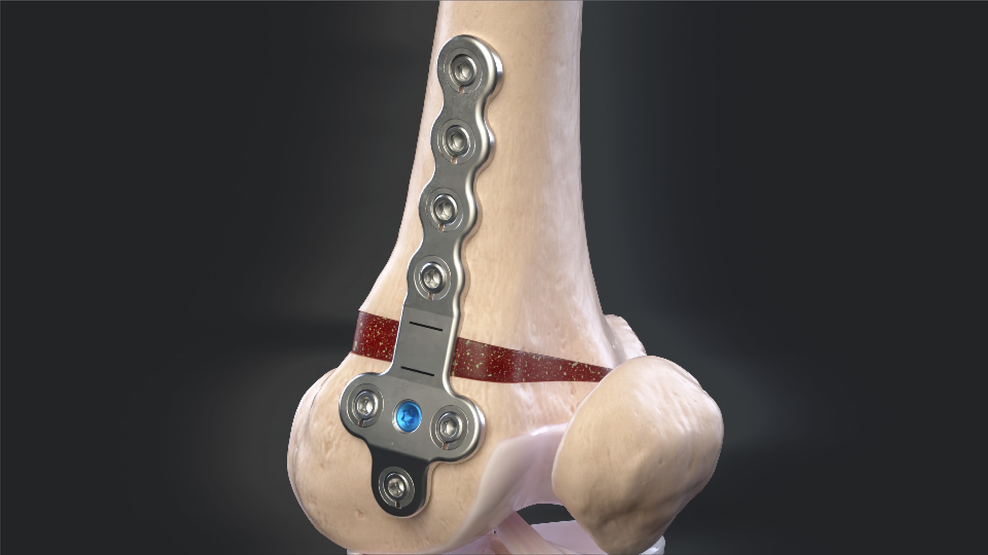 Arthrex - Distal Femoral Osteotomy