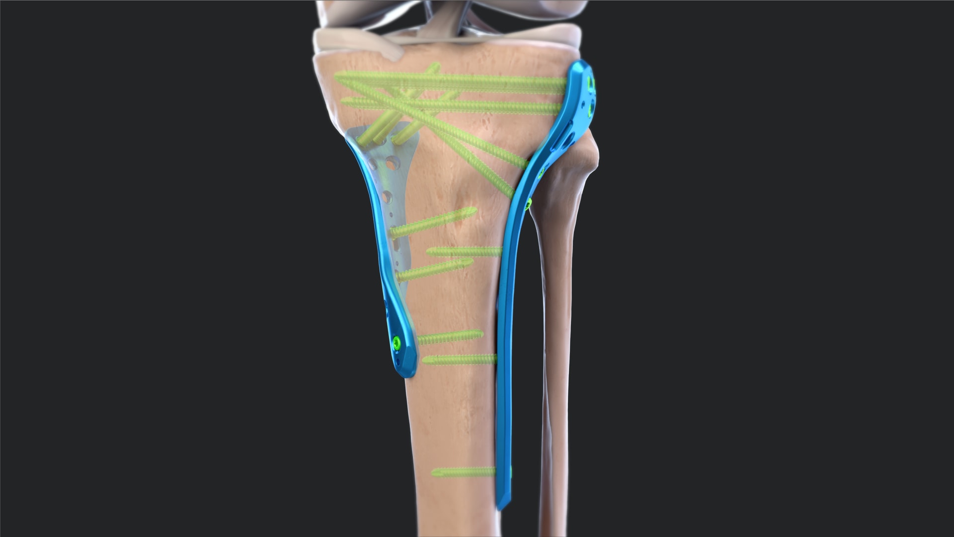 Proximal Tibia Plating System