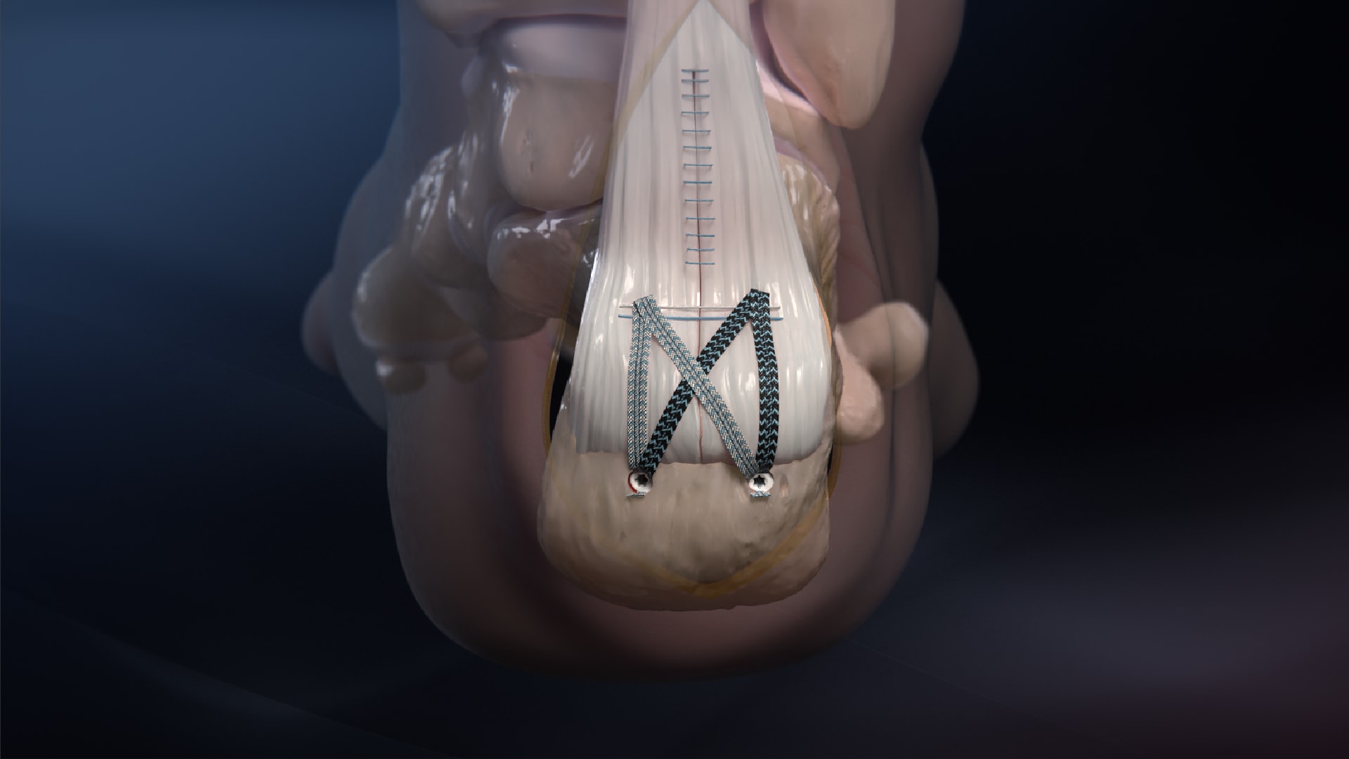 Open Achilles SpeedBridge™ Repair Technique