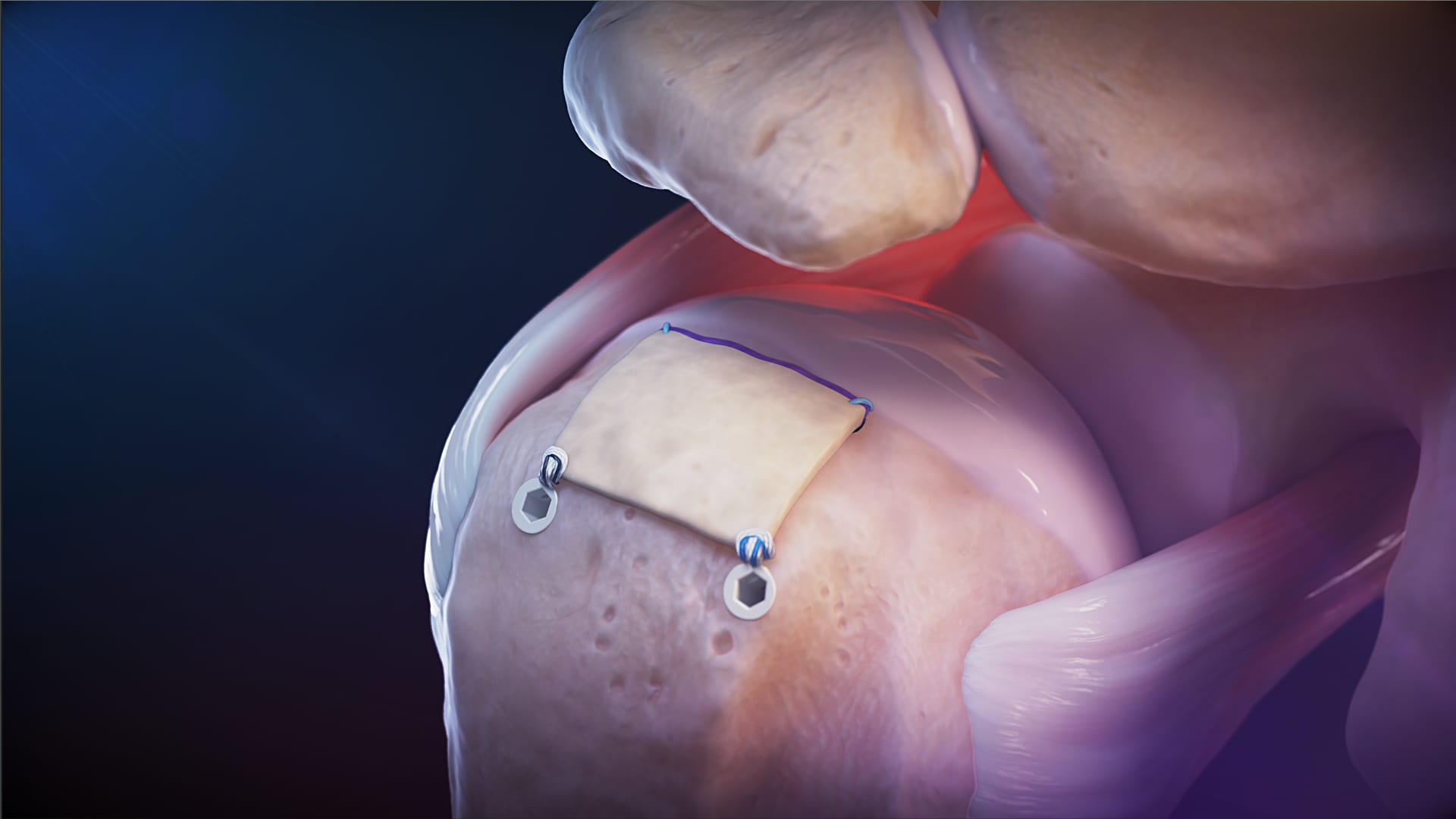 Tensionable Knotless Biologic Tuberoplasty With ArthroFLEX® Dermal Allograft