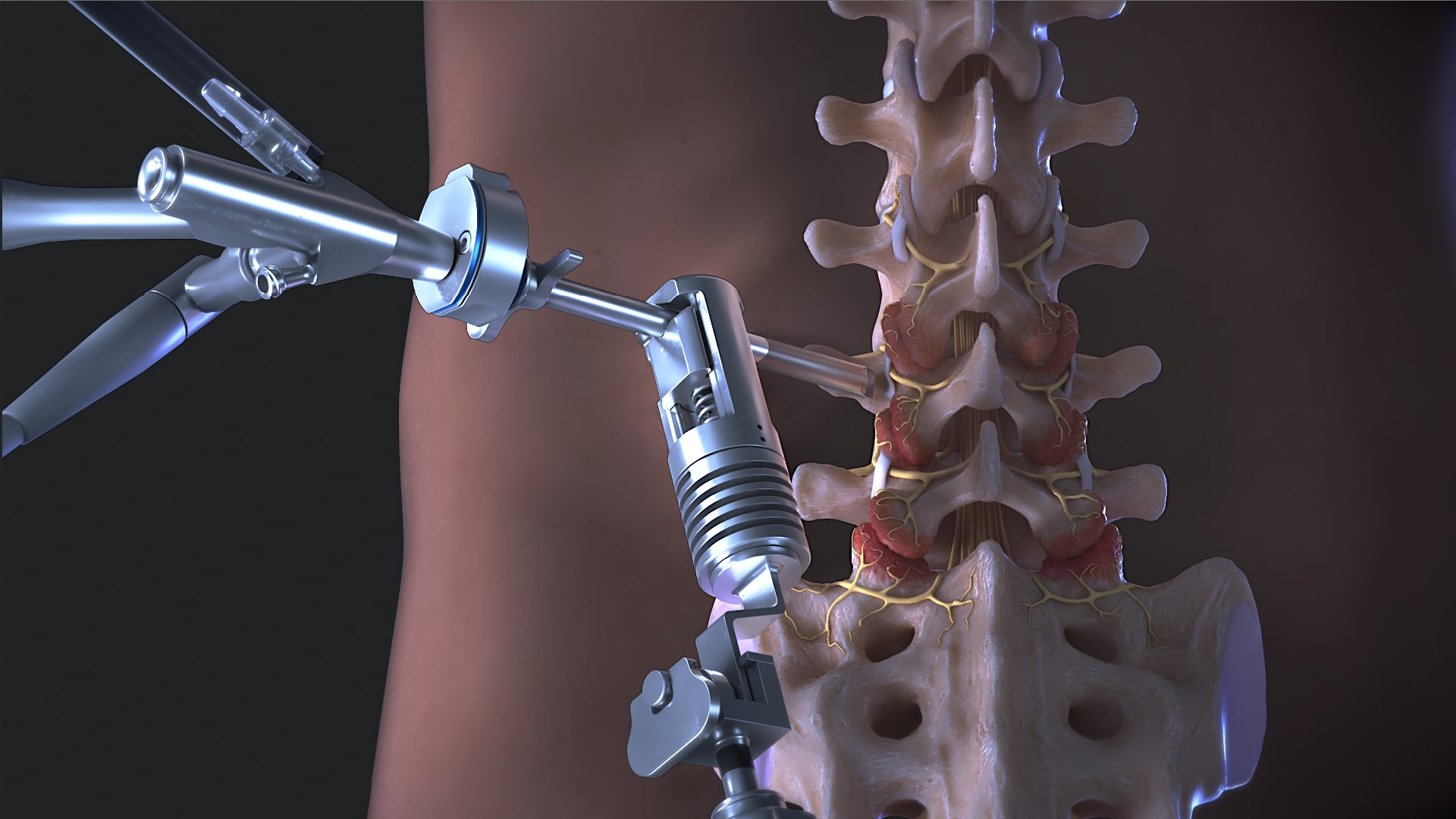 Medial Branch Nerve Transection With the Synergy<sup><i>ID</i></sup>™ System and Spine Endoscopes