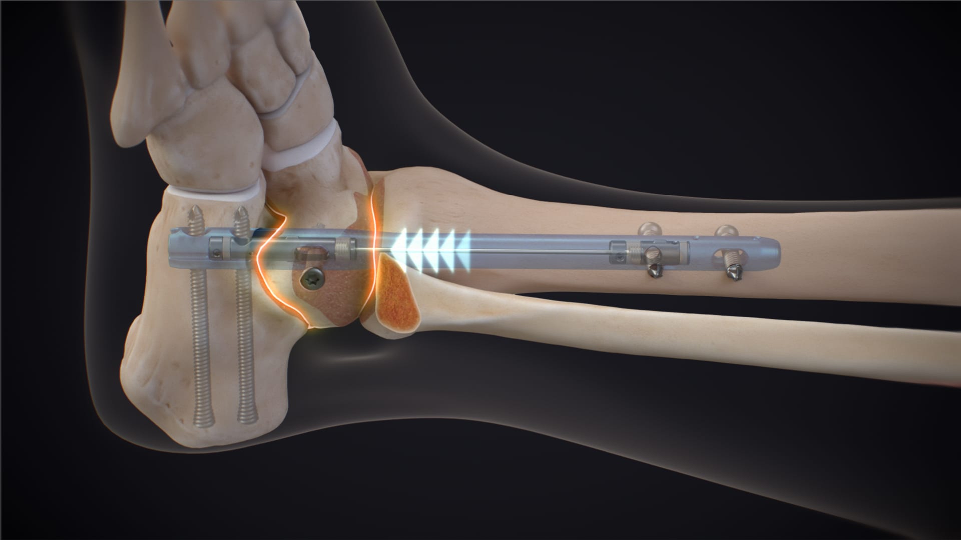 DualCompression Hindfoot Nail