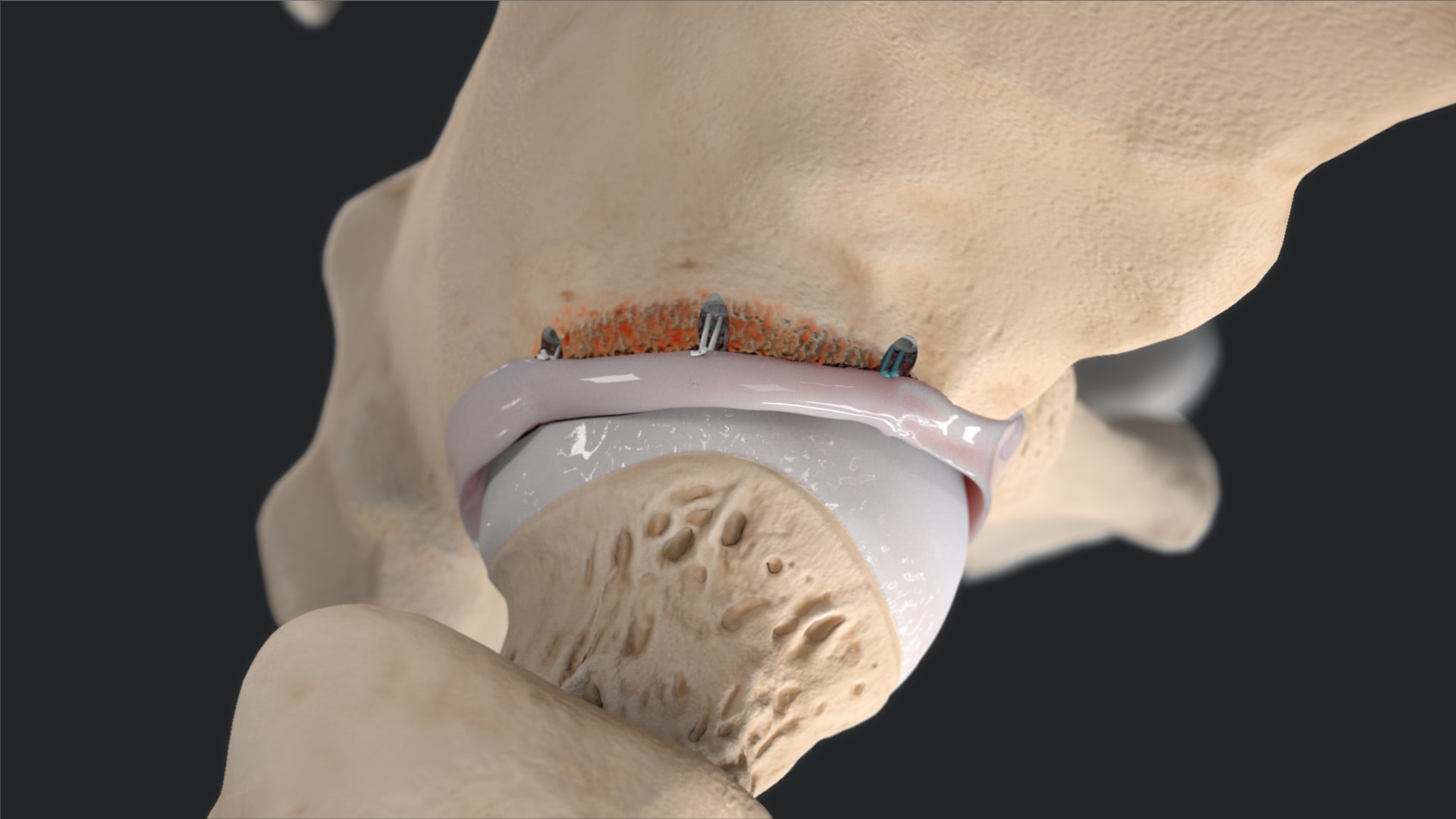 Hip Labral Reconstruction