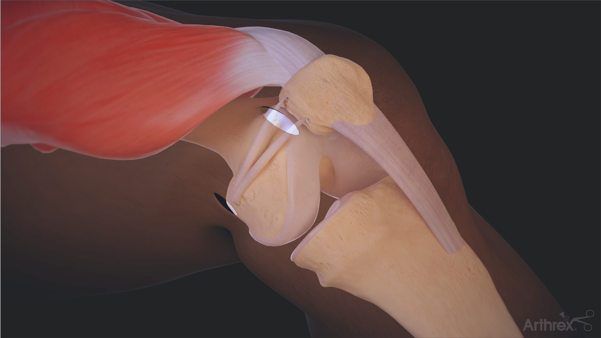 3.9 mm BioComposite SwiveLock® and TightRope® MPFL Implant Kit