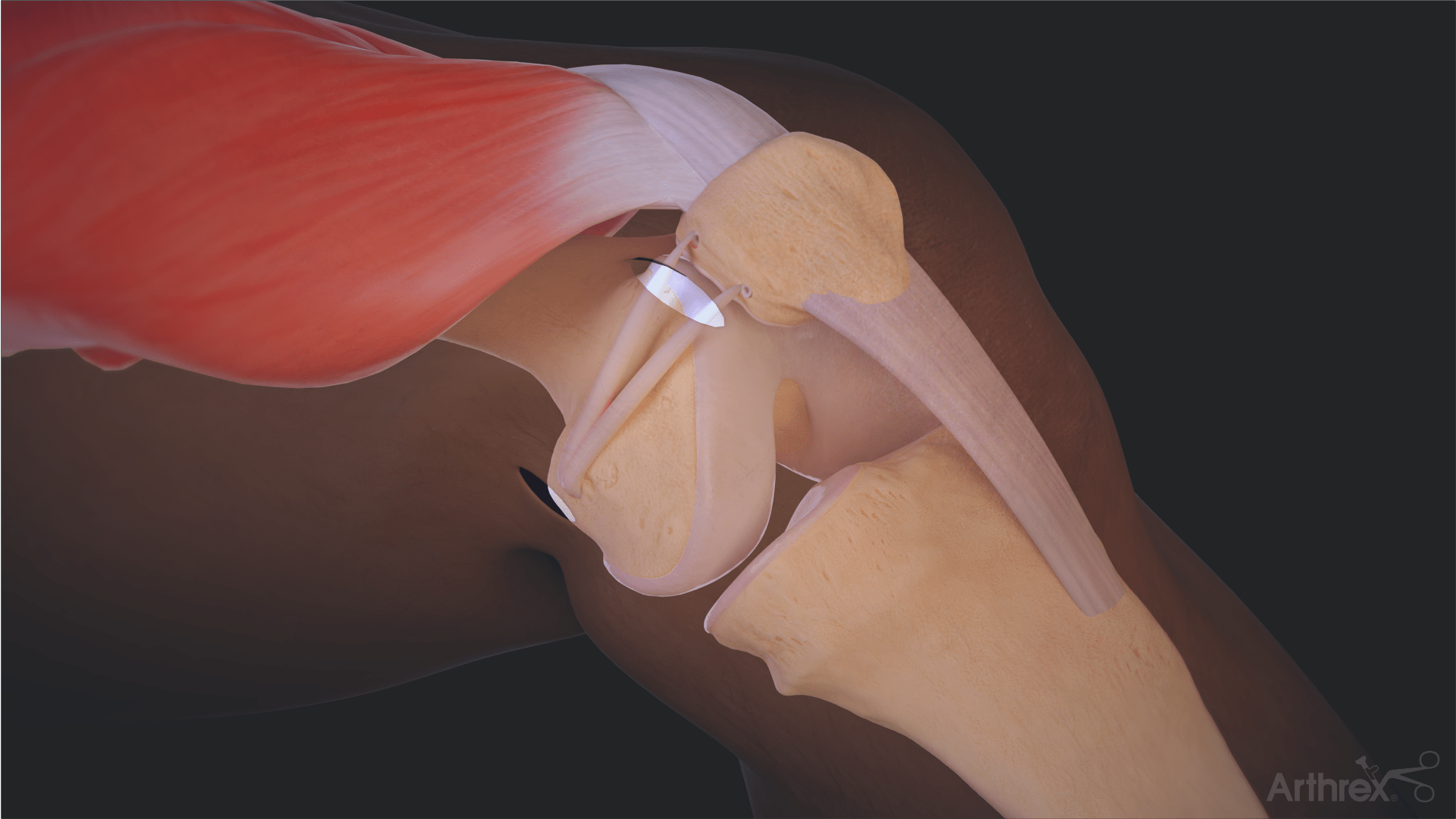 Arthrex - 3.9 mm BioComposite SwiveLock® and TightRope® MPFL Implant Kit