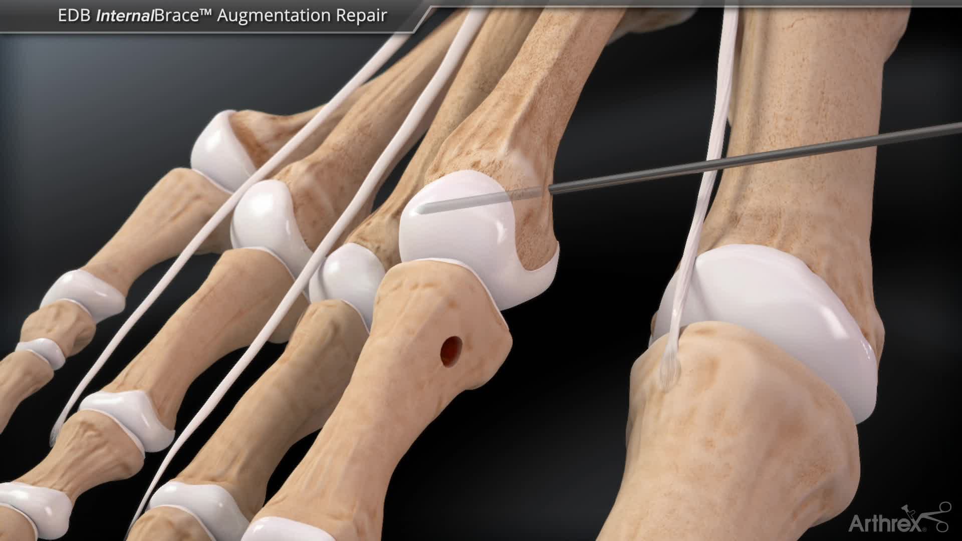 EDB InternalBrace™ Ligament Augmentation Repair