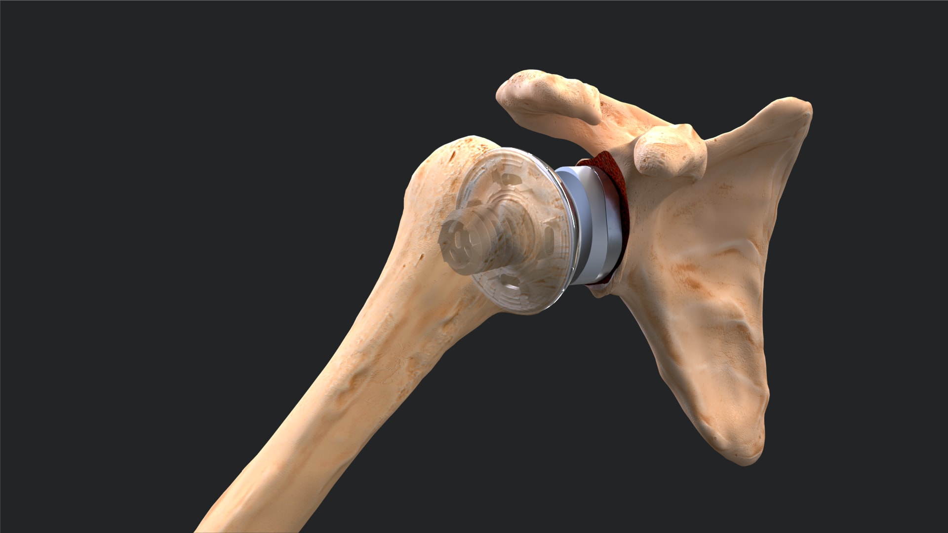 Arthrex - Univers Revers™ Universal Glenoid™ Convertible Baseplate