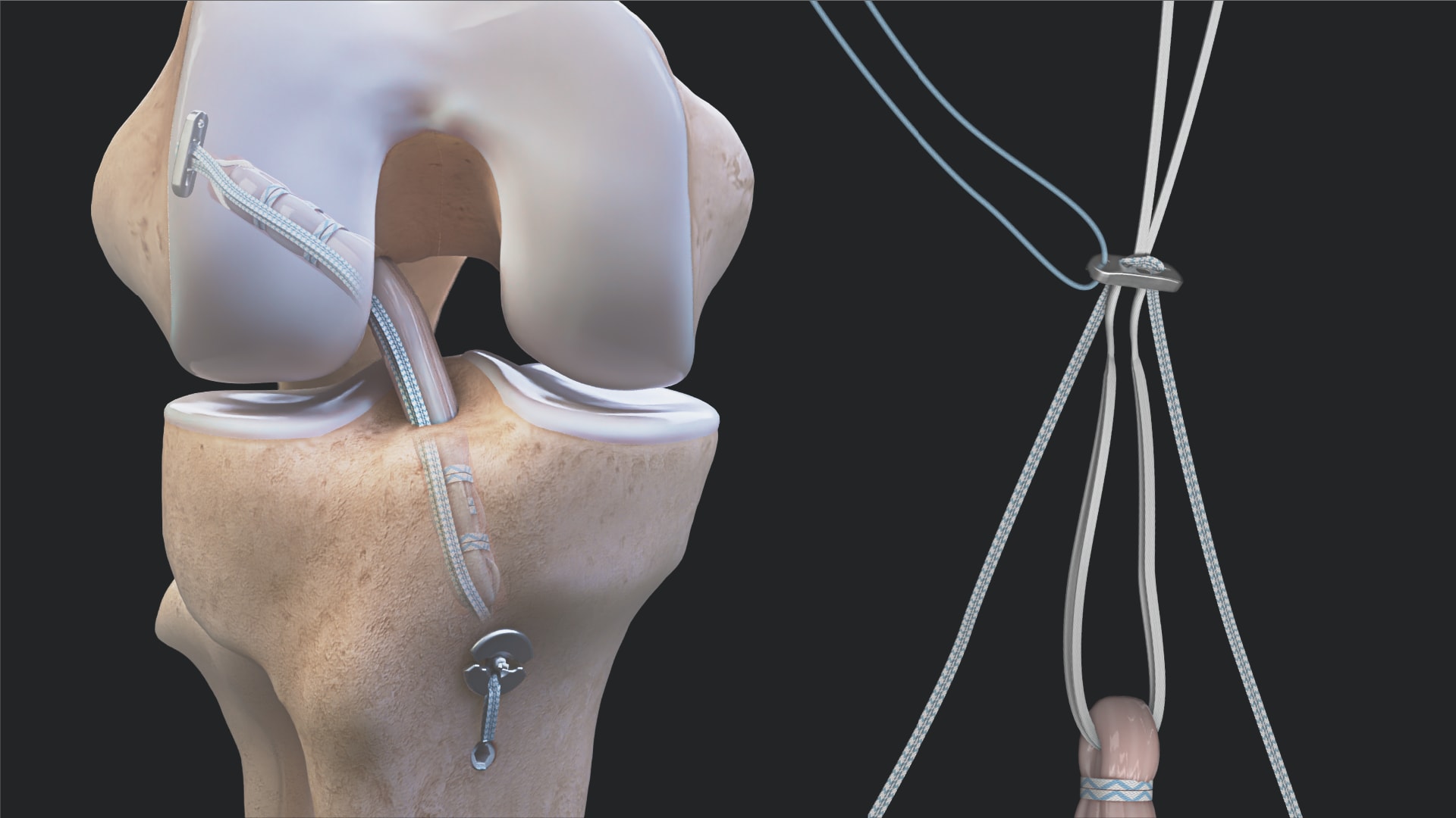 GraftLink® Technique Using FiberTape® Suture for the InternalBrace™ Technique 