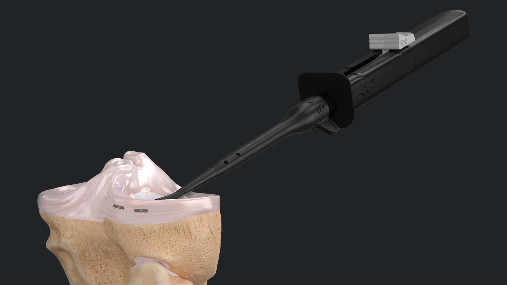 Meniscal Cinch™ II All-Inside Meniscal Repair