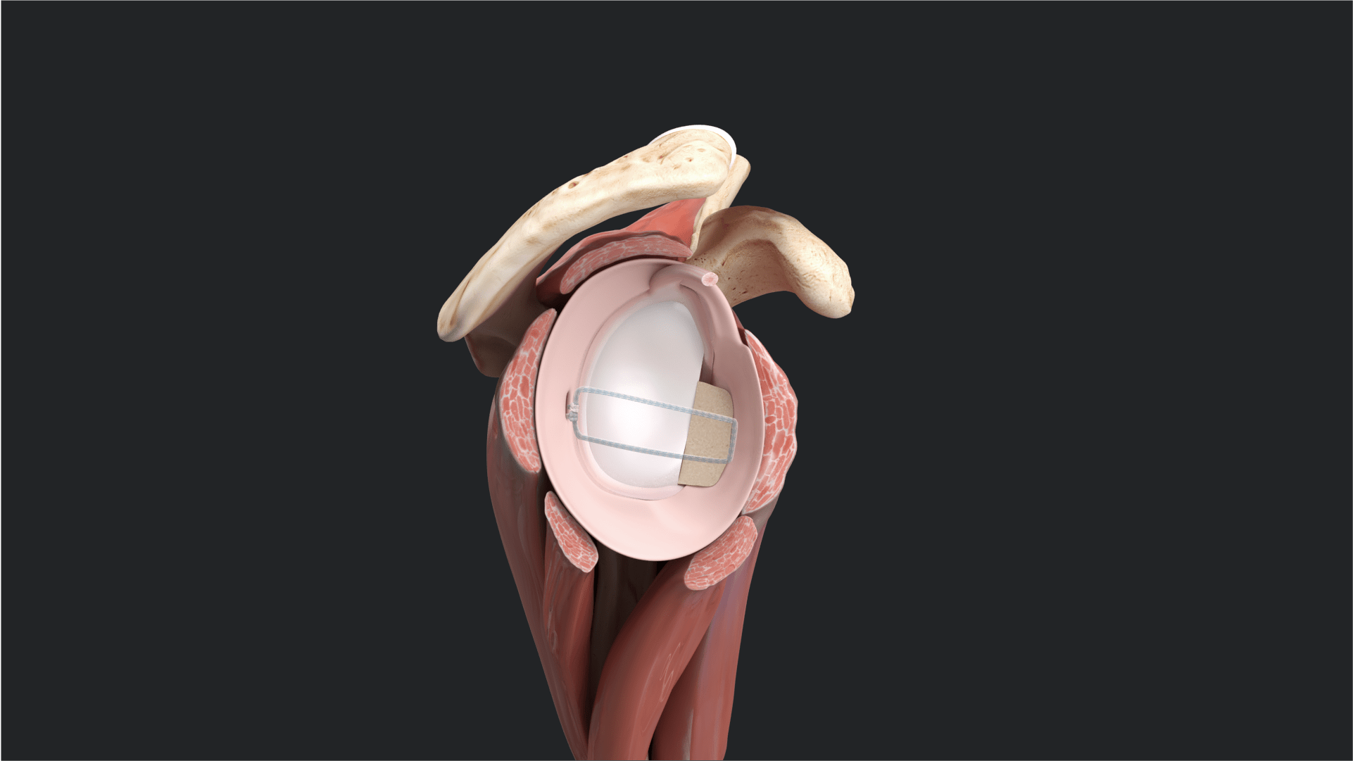 Bone Block Cerclage