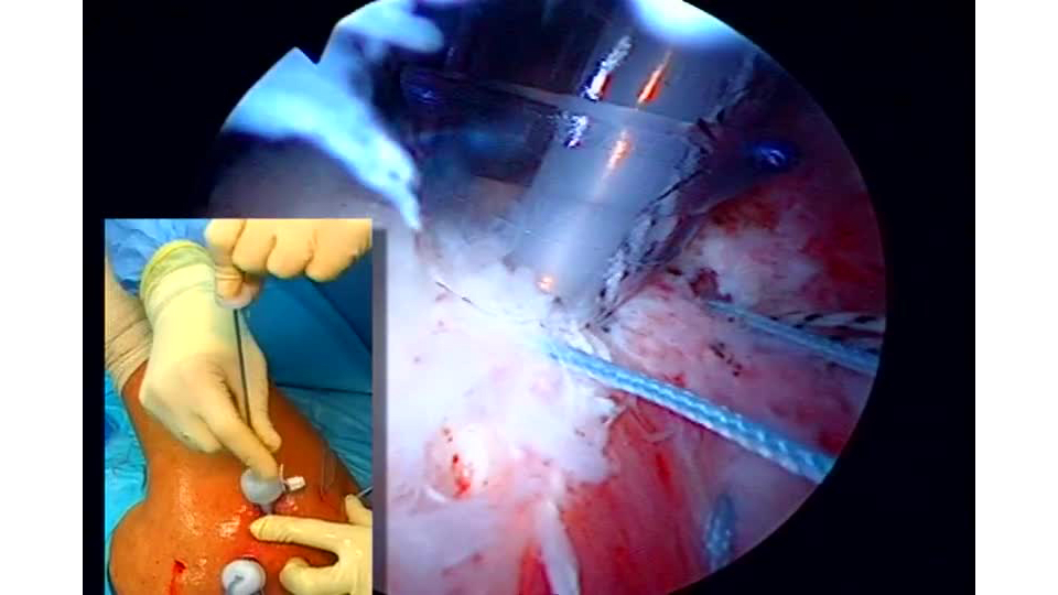 Placing Sutures In The Subscapularis