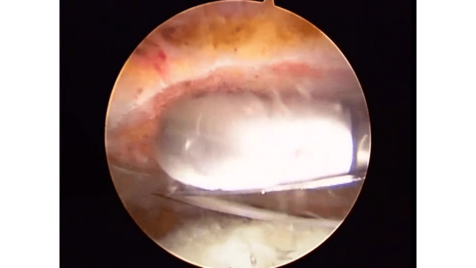 Suture Passing Strategies for Arthroscopic Rotator Cuff Repair